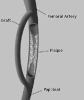 By-pass graft.