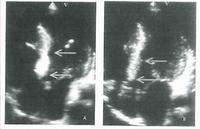 Echocardiogram measuring inter-ventricular size before (left) and after (right) septal ablation.