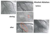 Angiography to select suitable septal arteries for alcohol infusion.