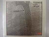 After balloon expansion and stent placement.