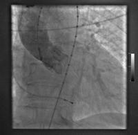 Aortic valve replacement.