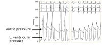 Intra-ventricular pressure gradient before and after septal ablation.