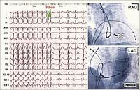 Electrocardiogram to find abnormal pathways.