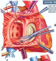 Excision of the inter-atrial septum to allow for the construction of the baffles.