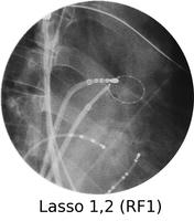 A Xray of a lasso use to ablate tissue.