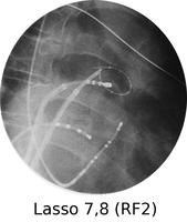 A Xray of a lasso use to ablate tissue.