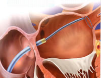 A diagram of the ablation procedure.