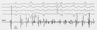 An electrogram of the pulmonary vein.