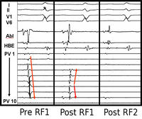 Electrical activity in the pulmonary vein.