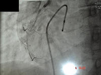 Long instent restenosis after multiple stents.
