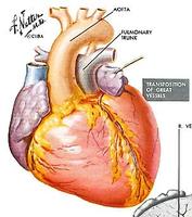 Transposition of the great arteries.