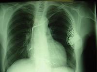 An Xray of a dual chamber pacemaker and defibrillator pacemaker.