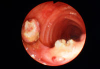 Colonic polyps.