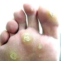 Plantar warts.