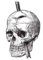 A short time after Gage died, his skull was exhumed and the crow-bar inserted through the skull defects.