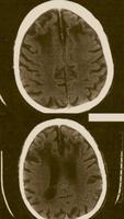 A CAT scan of a brain after leucotomy. The hypodense areas at eleven and one o'clock show the damage.